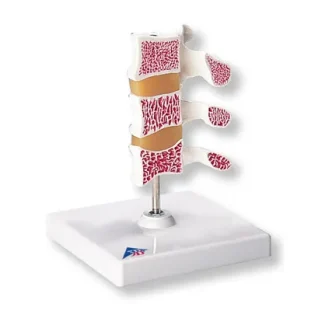 Luxusný model osteoporózy (3 stavce)