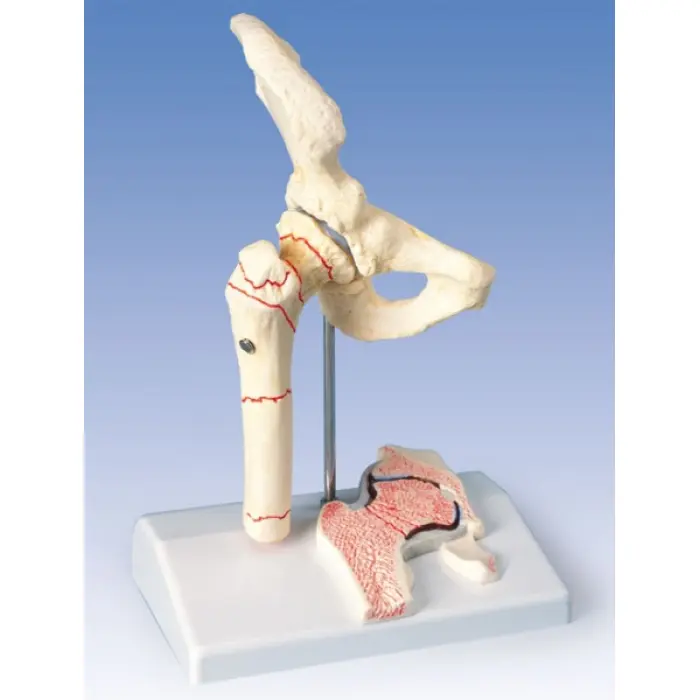A88 - Stehenná zlomenina a bedrová osteoartritída