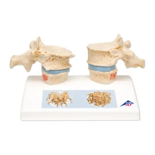Model osteoporózy