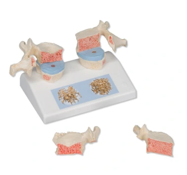 Model osteoporózy – Obrázok 2