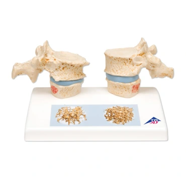 Model osteoporózy – Obrázok 3