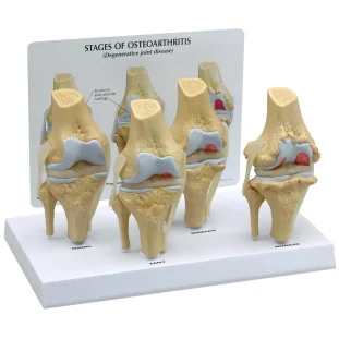 Kolenný kĺb, 4 stupne osteoartrózy