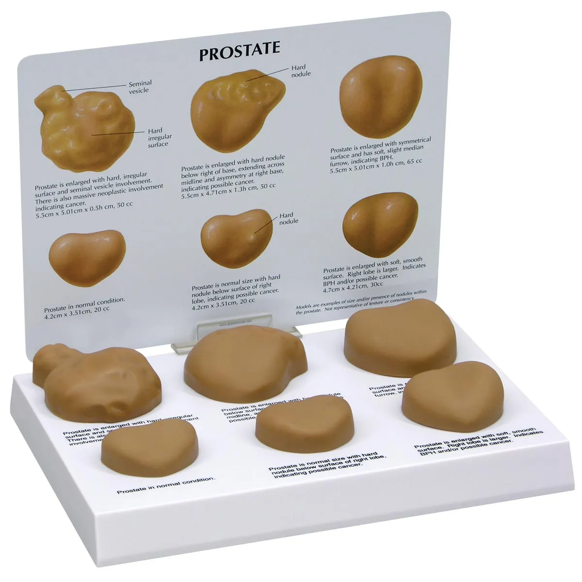 Model prostaty