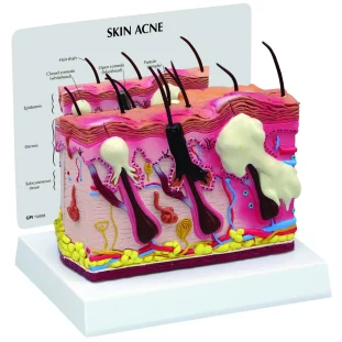 Obojstranný model akné